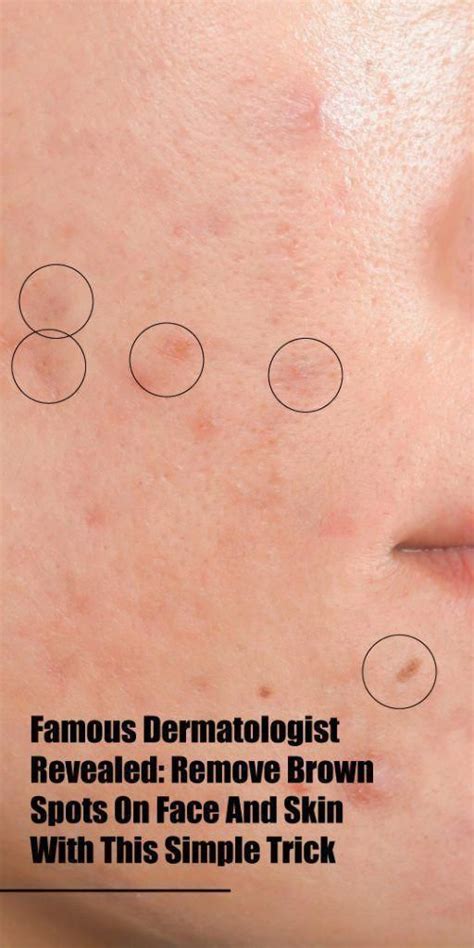 How You Can Remove Brown Spots On Deal With Obviously Brownspotsonskin