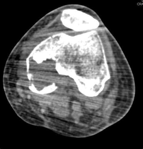 Fractured Aneurysmal Bone Cyst Femur Musculoskeletal Case Studies