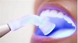 Cupping Teeth Treatment Pictures