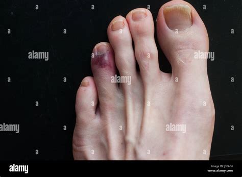 Broken Toe Showing Bruising On Skin Due To Injury Stock Photo Alamy