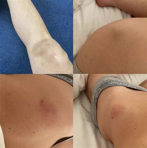 Dancing On Ice Star Caprice Shows Off Nasty Bruises After Ex Skating