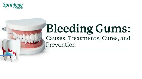 Bleeding Gums Causes Treatments Cures And Prevention Sprinjene