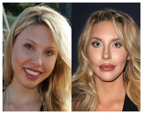 Chloe Lattanzi Before And After Plastic Surgery Pictures