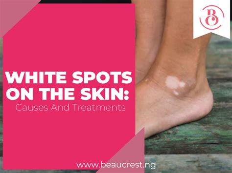 white spots on the skin causes and treatments beaucrest