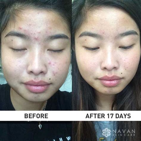 Normal cellular processes, as well as environmental insults like ultraviolet light and. TrueClear Results - Navan Skin Care