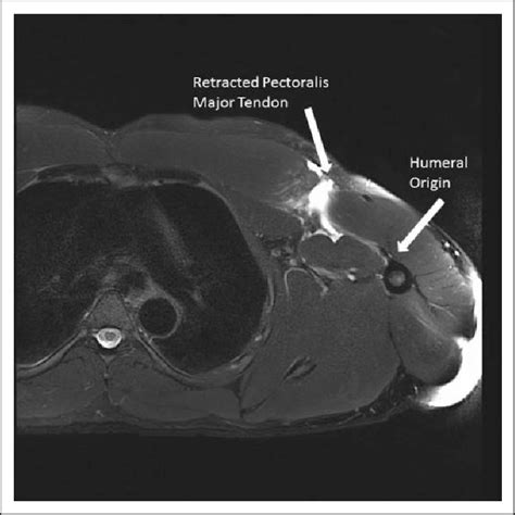 Most cases occur from indirect trauma in active men aged 20 to 40 years, especially during bench press. T2 axial MRI image of pectoralis major tear. MRI: magnetic ...