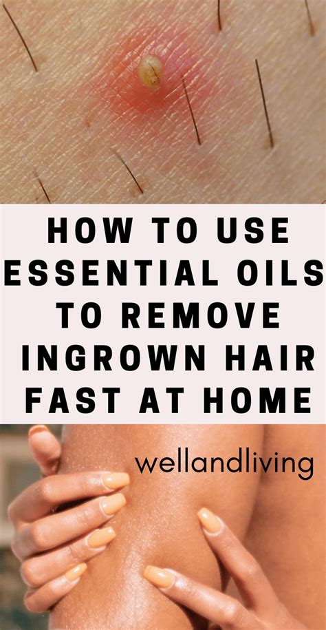 How To Use Essential Oils To Get Rid Of Ingrown Hair Fast At Home Well And Living Ingrown