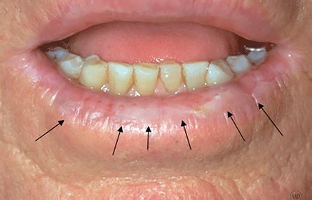 Skin Cancer Lips Lipstutorial Org