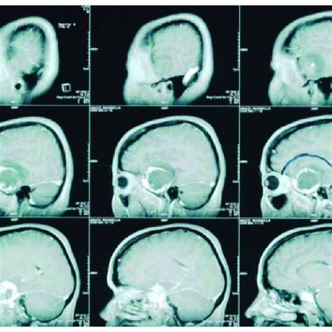 Early Sagittal Contrast Enhanced T1 Weighted Sequence Images Mri