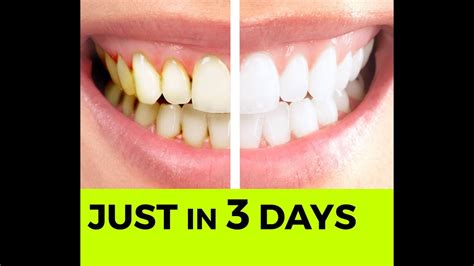 Baking Soda Tip How To Whiten Your Teeth Naturally Youtube