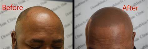 Finasteride Side Effects Dermimatch Hair Clinic Scalp