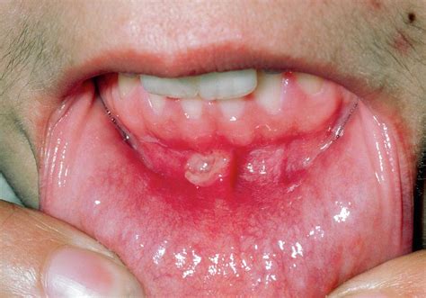 Aphtha Mouth Ulcer On Base Of Gums Photograph By Dr P Marazzi