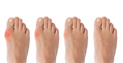 Arthritis In Foot Pictures