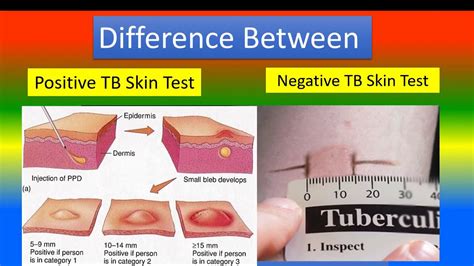 Difference Between Positive Tb Skin Test And Negative Tb Skin Test