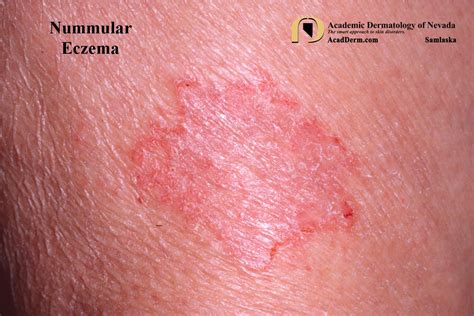 Nummular Eczema Academic Dermatology Of Nevada