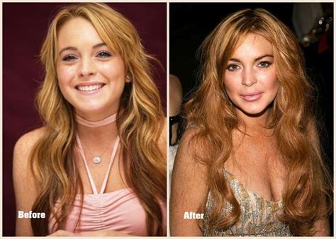 Épinglé sur celebrity plastic surgery before and after photos