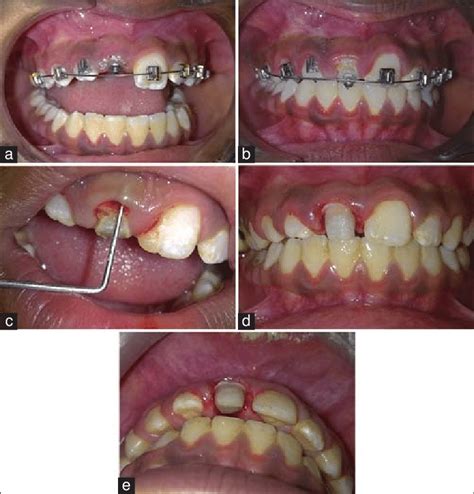 A Lingual Button Bonded On The Core B Intra Oral View After Two