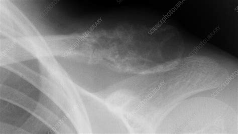 Ewings Sarcoma X Ray Stock Image C0443106 Science Photo Library
