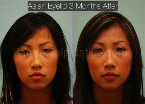 Asian Blepharoplasty Dallas Asian Eyelid Surgery Plano Tx