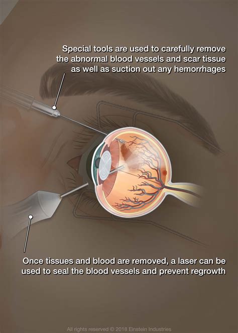 Diabetic Retinopathy Surgery