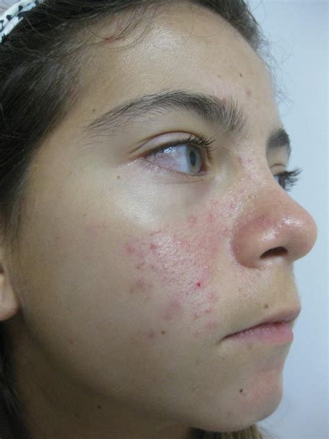 Acleara Acne Therapy Queens Long Island Nyc
