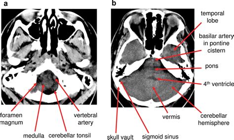 Normal Anatomy Of The Brain On Ct And Mri With A Few Normal Variants