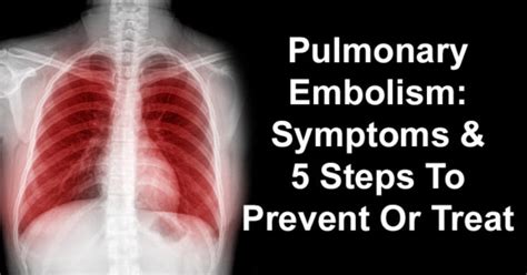Pulmonary Embolism Symptoms And 5 Steps To Prevent Or Treat David
