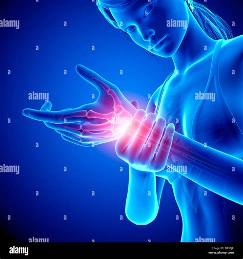 Wrist Pain Artwork Stock Photo Alamy
