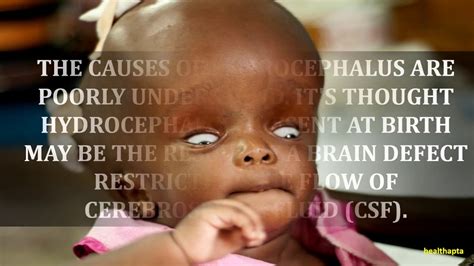 Causes Of Hydrocephalus Youtube