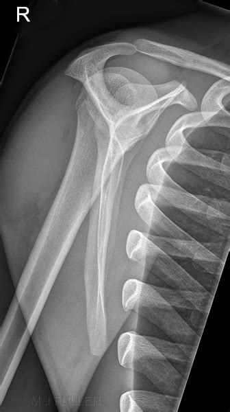 Radiografi Av Lateral Scapula Wikiradiografi Great Journey