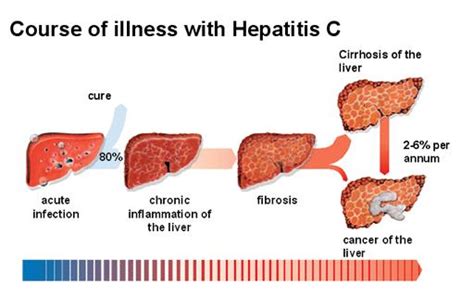 Hepatit c, oldukça yaygın görülen virüs kaynaklı bulaşıcı bir enfeksiyondur. Hepatitis C Virus - Microbiology - Medbullets Step 1