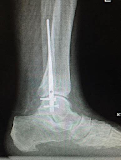 Icd 10 Left Tibial Plafond Fracture