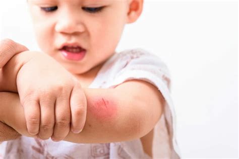 How To Deal With Minor Injuries In Children Childhealthy