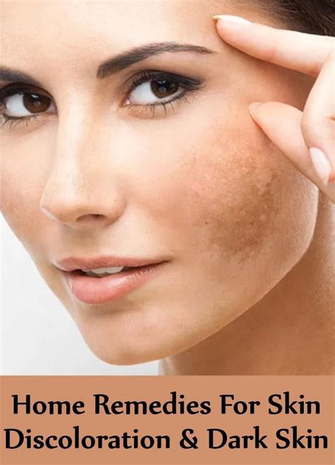 Home Remedies For Skin Discoloration And Dark Skin Skin Discoloration