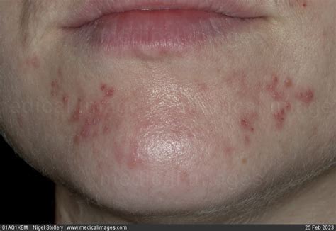 Stock Image Dermatology Perioral Dermatitis A Spread Of Small Red