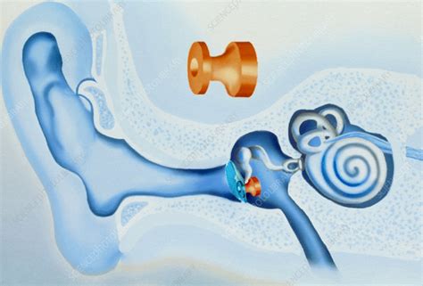 Artwork Showing A Grommet In Place In The Eardrum Stock Image M157