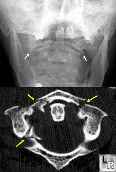 Jeffersons Fracturec2spinetraumafracture