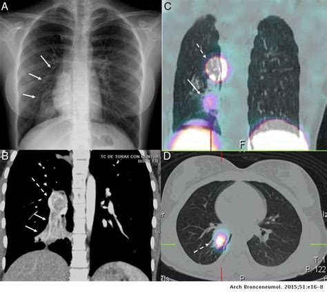 Recurrent Pneumonia Due To Bronchial Carcinoid Tumour In A Young