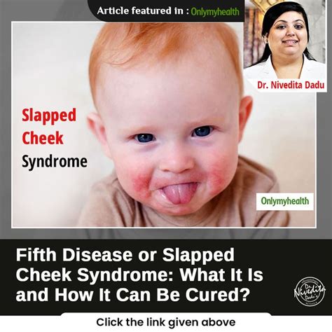 Fifth Disease Or Slapped Cheek Syndrome What It Is And How It Can Be