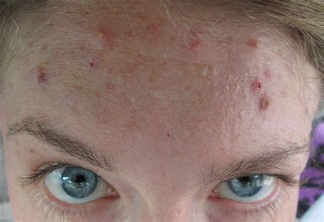 Forehead Acne Home