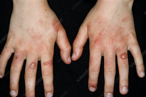 Streptococcal Rash On The Hands Stock Image C Science