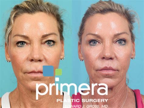 Blepharoplasty Before And After Pictures Case 689 Orlando Florida
