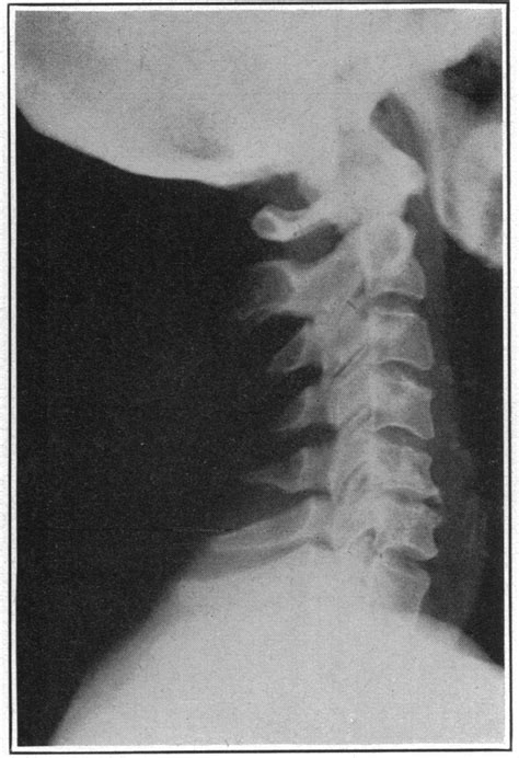 Osteoarthritis Of The Cervicodorsal Spine Radiculitis Simulating