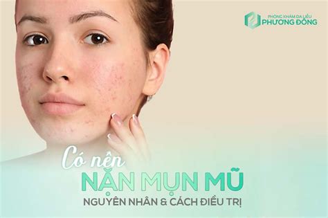 Có Nên Nặn Mụn Mủ Hay Không Hướng Dẫn And Lưu ý Nặn Mụn Mũ đúng Cách