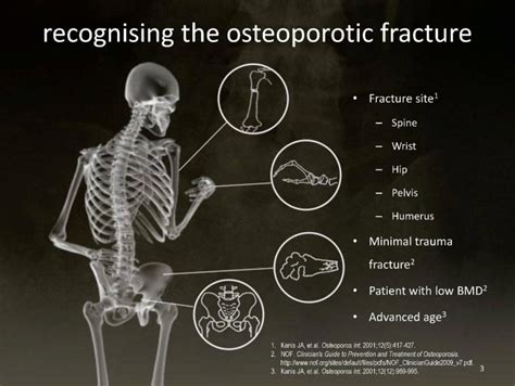 Osteoporosis Menopause Facts