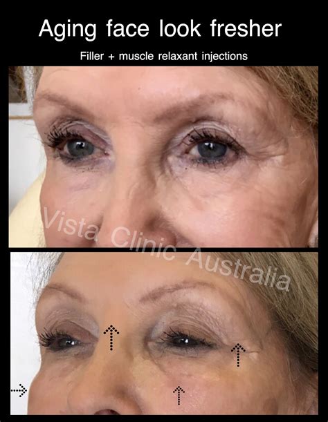 Eyes Before And After Vista Clinic Melbourne