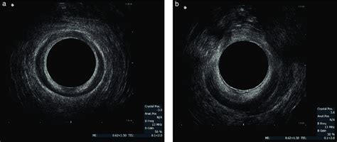 Endoanal Ultrasound Images At Superficial Level Of Internal Anal Download Scientific Diagram