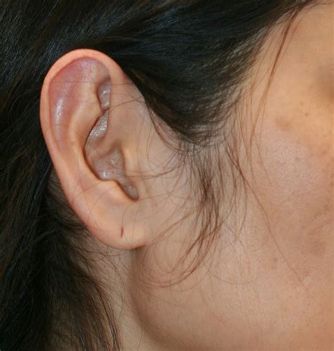 Ear Reduction Before And Afters David Gault Frcs