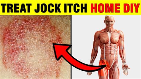 jock itch tinea cruris causes risk factors signs 46 off