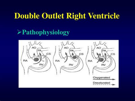 Ppt Double Outlet Right Ventricle Powerpoint Presentation Free